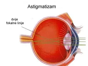Leo Angart - astigmatizam oka i lečenje