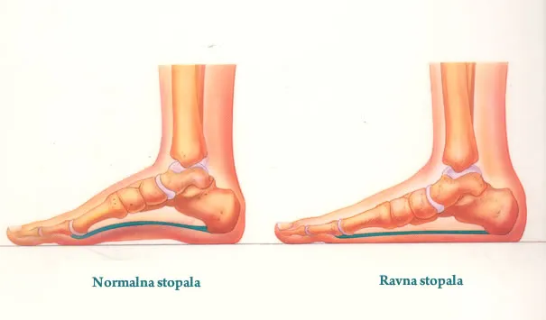 ravna-stopala