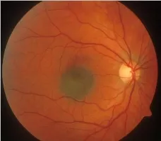 nevus-horioidee