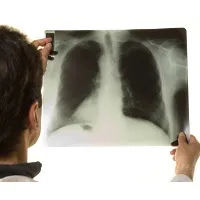 pneumotoraks