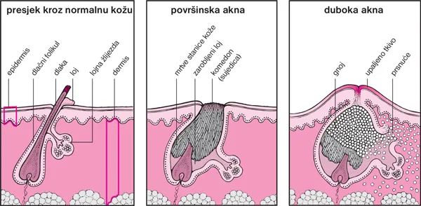 akne