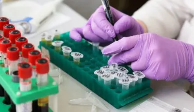 laboratorija dijabetes.jpg Laboratorija dijagnoza dijabetes