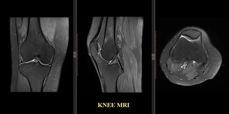 Magnetna rezonanca kolena (MRI kolena) 