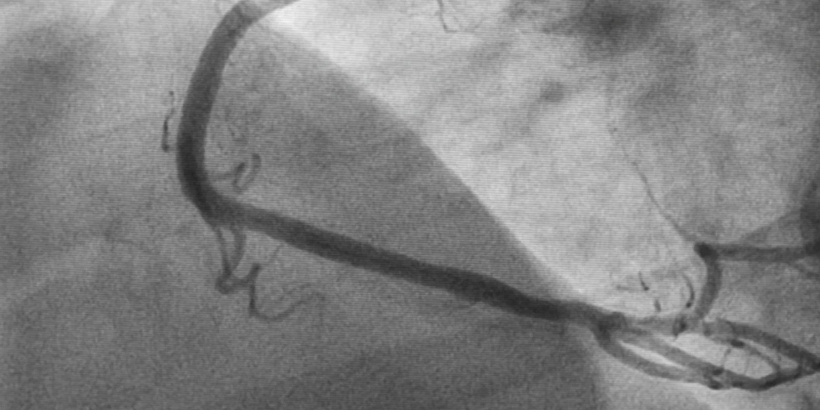 koronarna angiografija