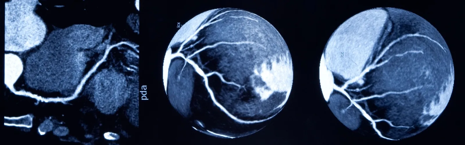 koronarna angiografija coronary angiography (2).jpg