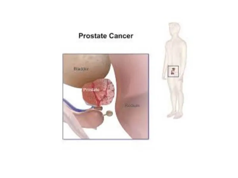 Otkriven genski indikator raka prostate