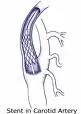 Stent u začepljenju karotidnih arterija - Hit u vaskularnoj medicini