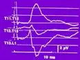 Elektroneurografija (ENG)