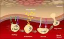 Psorijaza (Psoriasis vulgaris)