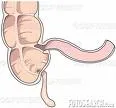Akutni apendicitis (Upala slepog creva)