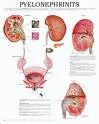 Pijelonefritis
