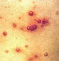 Molluscum contagiosum
