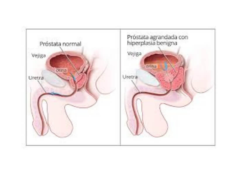 Benigna hiperplazija prostate