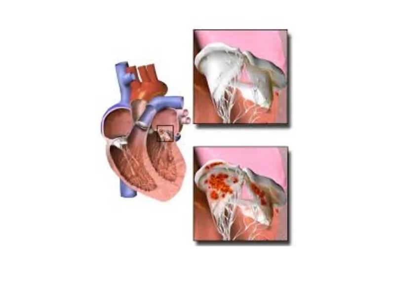Endokarditis