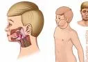 Zauške (Parotitis epidemica)