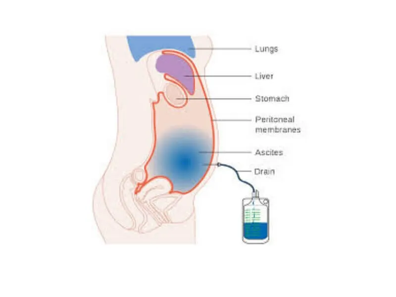 Ascites
