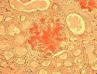 Amiloidoza