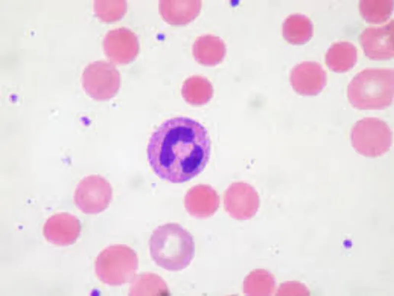 Hemolizne anemije