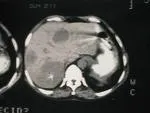 Insulinom