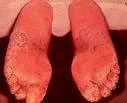 Atletsko stopalo (Tinea pedis)