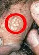 Genitalni herpes