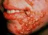 Impetigo contagiosa