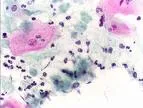 Trihomonas infekcija (Trichomoniasis)