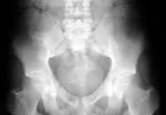 Osteomalacija