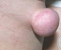 Lipom