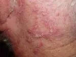 Seboreja (Seboroični dermatitis)