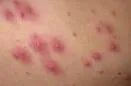 Folikulitis