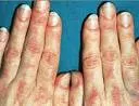 Dermatomiozitis