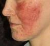 Rozacea (Rosacea)