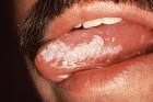 Leukoplakija