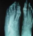 Osteomijelitis