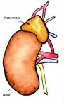 Konov sindrom (Conn syndrome)