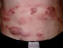 Mycosis fungoides