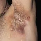 Hidradenitis suppurativa