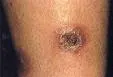 Ektima (Ecthyma)