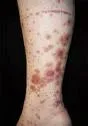 Henoch-Schonlein purpura