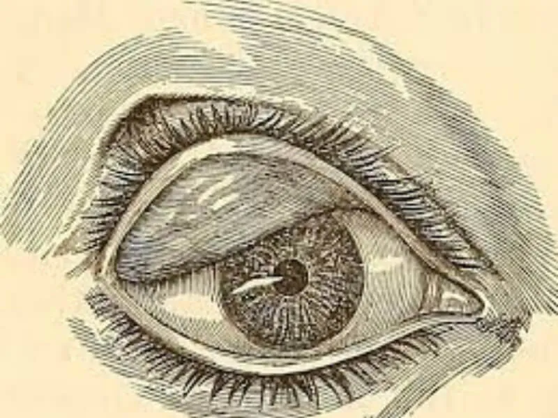 Ectropium (Ektropijum)