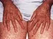 Xeroderma pigmentosum