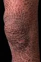 Ihtioza (Ichthyosis)