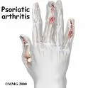 Psorijazni artritis