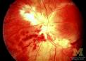 Retinitis