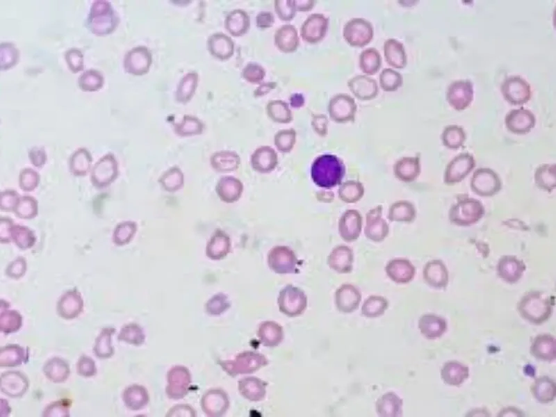 Fanconi anemija
