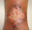 Pyoderma gangrenosum