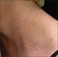 Pseudoxantoma elasticum