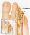 Morton neuroma (Interdigitalni neurom)