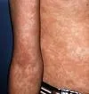 Erythema infectiosum